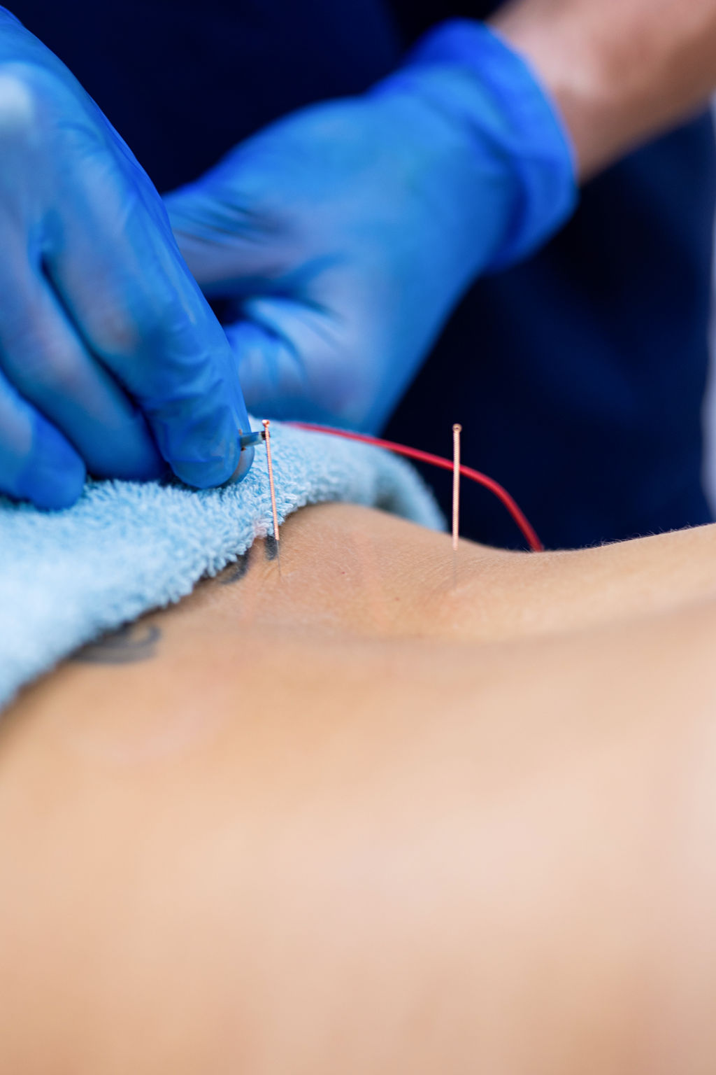 Acupuncture for pain relief in Birmingham